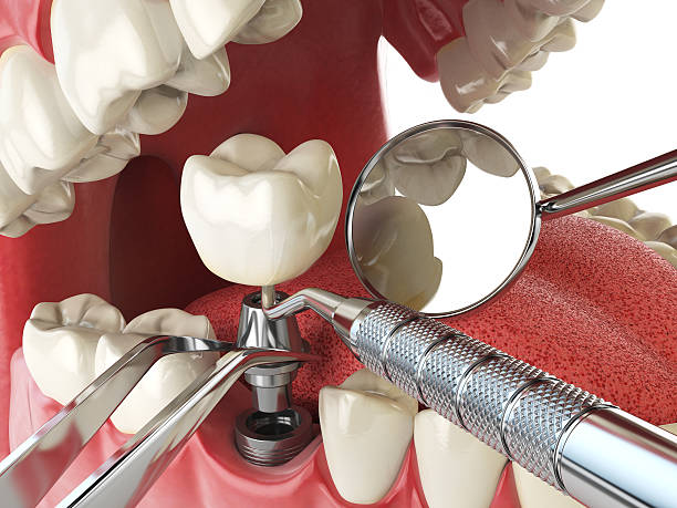 Best Emergency Dental Extractions in Barrett, TX